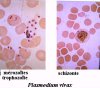 Formes trophozoïte, mérozoïtes et schizonte de Plasmodium vivax dans un frottis sanguin (microscopie optique)